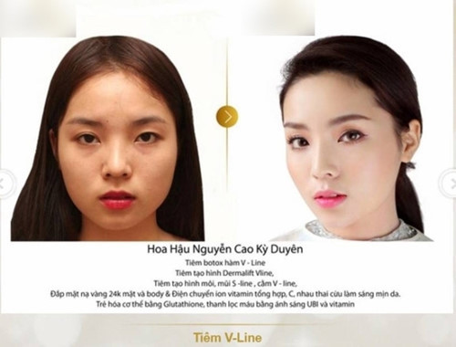 Dẫu vậy, bằng chứng lại lộ ra khi một thẩm mỹ viện tung bức ảnh Kỳ Duyên trước và sau khi sử dụng các dịch vụ làm đẹp tại đây. Trước những bằng chứng này, Kỳ Duyên không có phản hồi nào. Gần đây cô nàng còn đi cải thiện vòng 1.