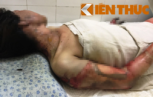 Nạn nhân Nguyễn Thị Hồng đang cấp cứu tại Bệnh viện ĐKKV Thủ Đức trong tình trạng bỏng rất nặng, hơn 35% diện tích cơ thể. Tuy nhiên hiện tại nạn nhân không có người thân để chăm sóc.