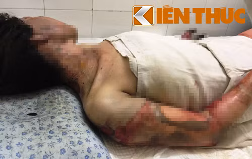 Nạn nhân Nguyễn Thị Hồng đang cấp cứu tại Bệnh viện ĐKKV Thủ Đức trong tình trạng bỏng rất nặng, hơn 35% diện tích cơ thể. Tuy nhiên hiện tại nạn nhân không có người thân để chăm sóc.