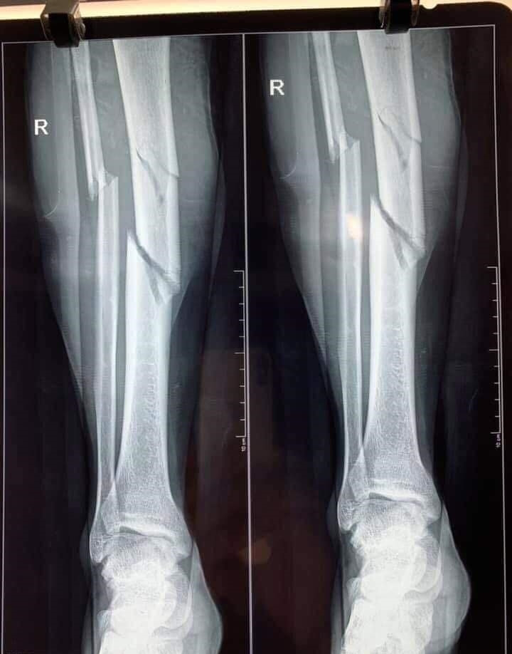 Cau thu don gio” doi phuong khien xuong gay 3 khuc-Hinh-4