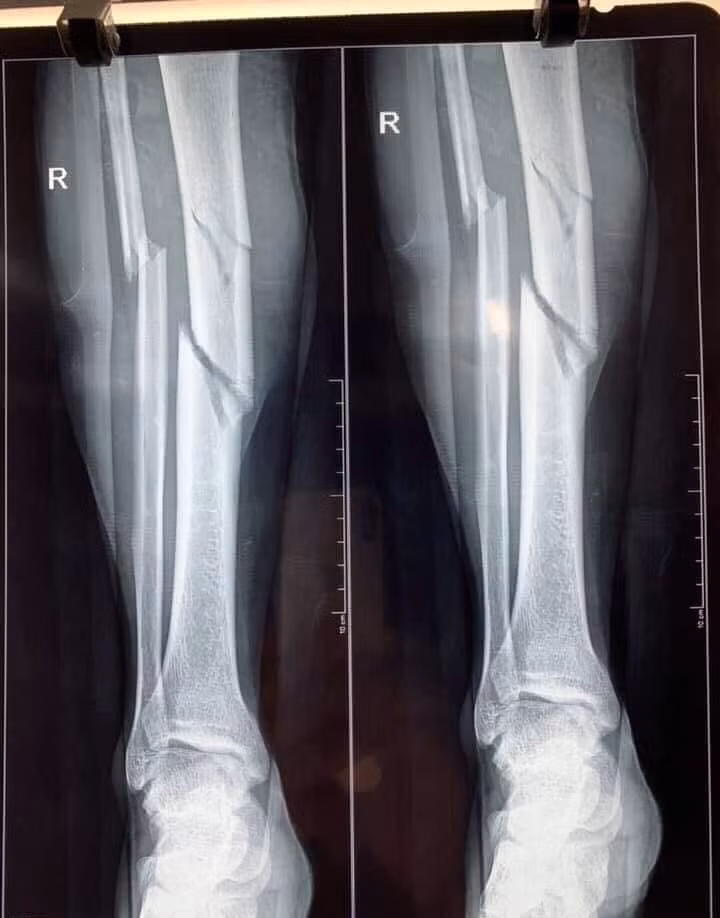 Cau thu don gio” doi phuong khien xuong gay 3 khuc-Hinh-4