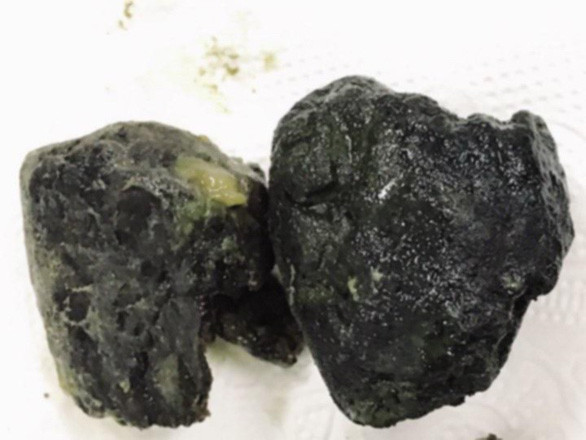 Tac ruot vi thuong xuyen nuot chung vien tran chau trong tra sua