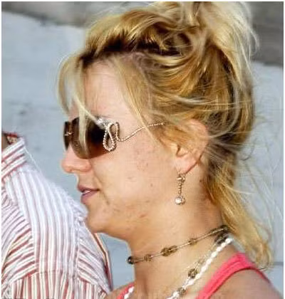 Khuôn mặt đầy mụn cùng mái tóc tổ quạ là hình ảnh Britney Spears gây ấn tượng xấu trong lòng người hâm mộ. Ảnh: stylecraze