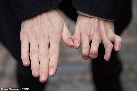 Bàn tay mới được thay thế của Richard.