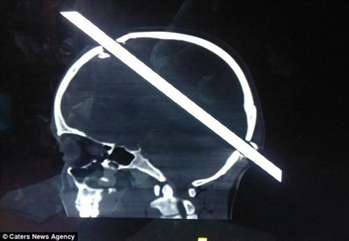 Hình ảnh chụp X-quang cho thấy thanh sắt xuyên hoàn toàn qua hộp sọ của Guddu.