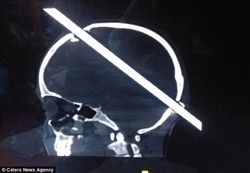 Hình ảnh chụp X-quang cho thấy thanh sắt xuyên hoàn toàn qua hộp sọ của Guddu.