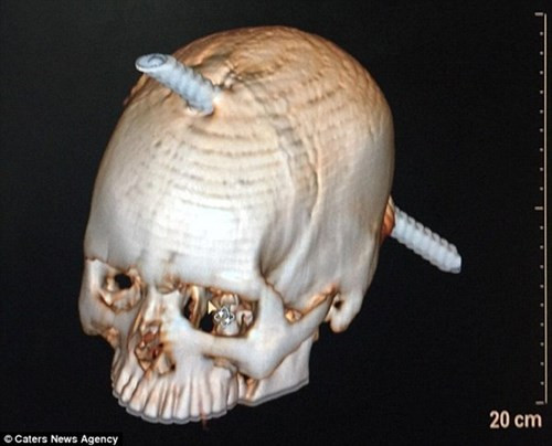 Thực tế thanh sắt đã xuyên qua vùng không có chức năng quan trọng của não nên Guddu sống sót.