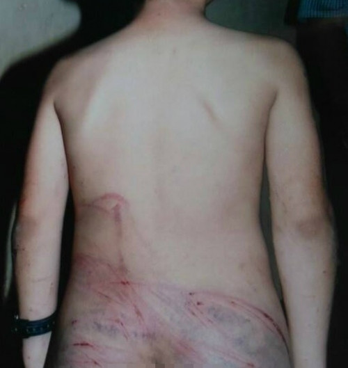 Vết thương tím tái trên người của em Bùi Phạm Khánh D. vì bị bố đánh bằng dây điện.