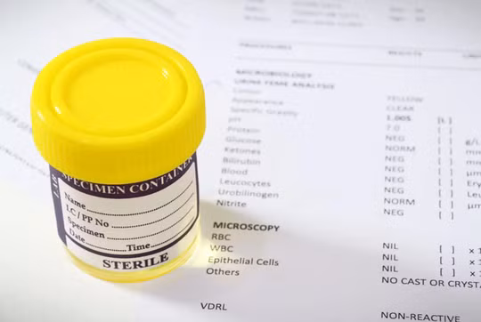 Xét nghiệm nước tiểu sẽ "thần kỳ" hơn nhờ hóa chất mới được các nhà khoa học Trung Quốc tìm ra - ảnh: LIVE SCIENCE