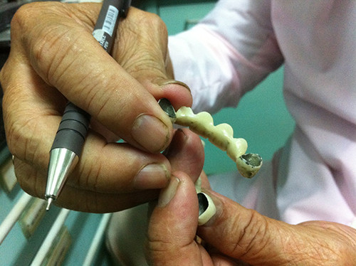 BSCK II Trần Ngọc Đỉnh giải thích nguyên nhân đen viền nướu chân răng do oxy hóa trong răng bọc sứ kim loại.