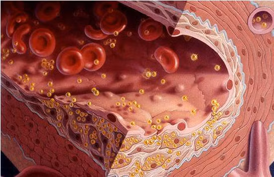 Có thể nói mỡ máu cao là nguy cơ tiềm ẩn của nhiều bệnh nguy hiểm. Vì thế, phải giữ mỡ máu ở mức độ bình thường cho phép để phòng ngừa các bệnh nguy hiểm phát sinh từ nguy cơ do mỡ máu cao. 