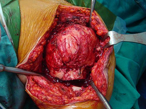 Kinh di cat u xuong canh tay to nhu qua bong o HN-Hinh-2