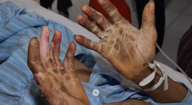 Đây là căn bệnh nguy hiểm có thể khiến bạn bị hoại tử, thậm chí tử vong sau khi mắc phải.