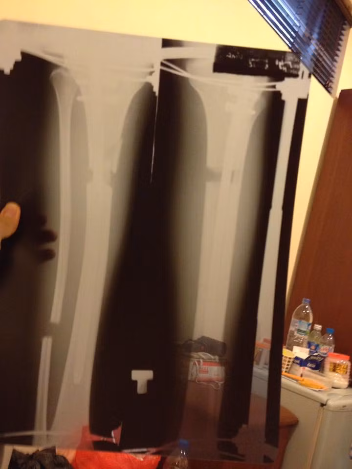 Chang trai 1m67 chia se hanh trinh keo dai chan len 1m76-Hinh-4