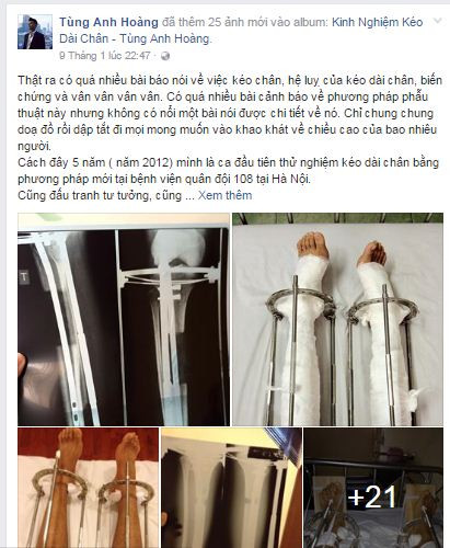 Chang trai 1m67 chia se hanh trinh keo dai chan len 1m76-Hinh-2