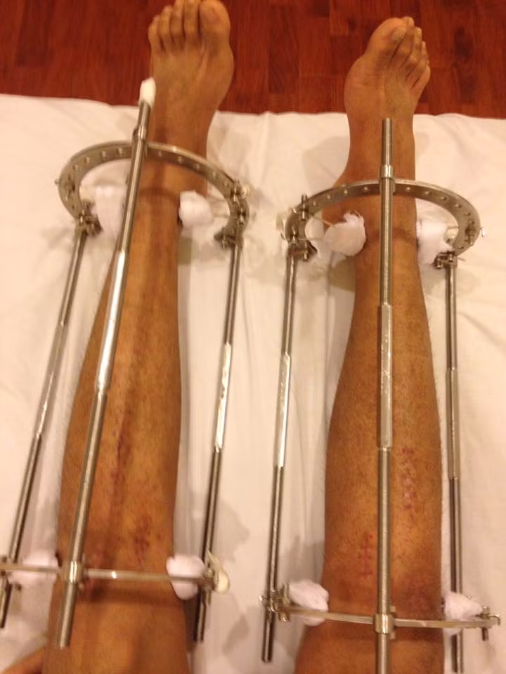 Chang trai 1m67 chia se hanh trinh keo dai chan len 1m76-Hinh-5