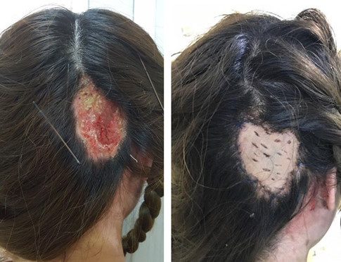 Thieu nu bong nang, hoai tu da dau sau hap duong toc