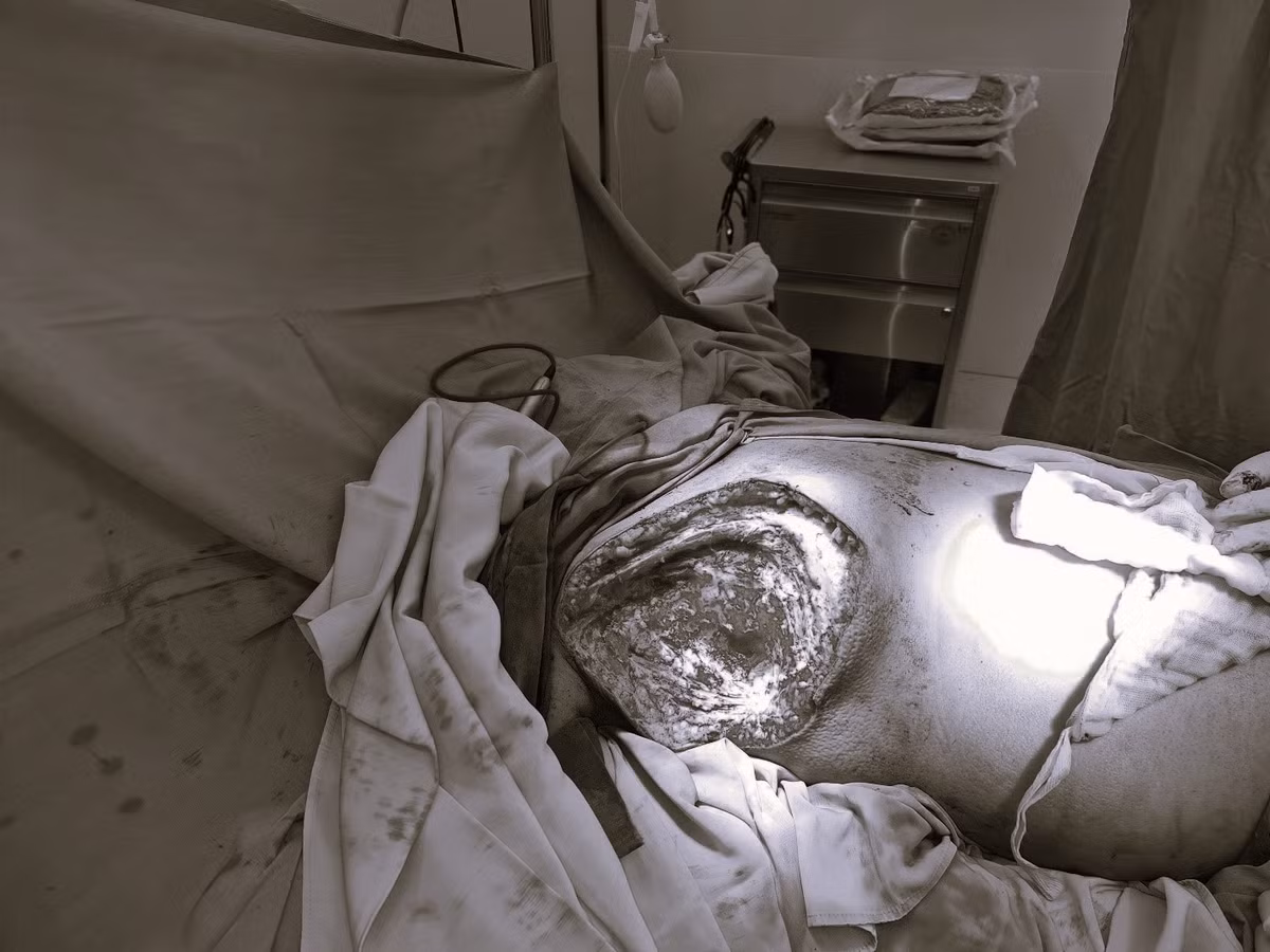 U vu lon dan, sung do, loet: Coi chung ung thu vu-Hinh-2