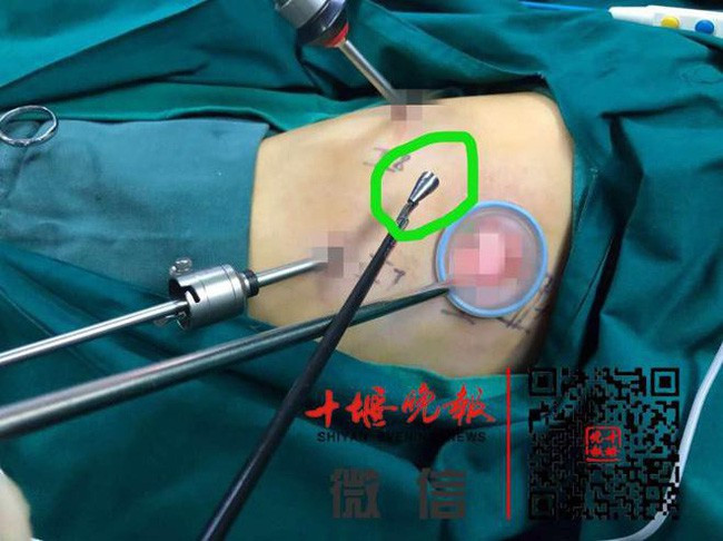 Be gai 8 tuoi suyt mat mang, bac si phat hien thu khung khiep