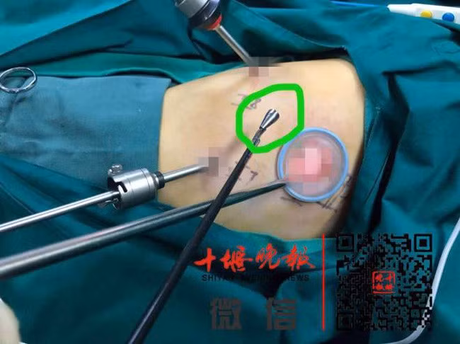 Be gai 8 tuoi suyt mat mang, bac si phat hien thu khung khiep