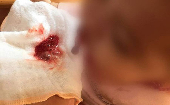 Viem tuy cap o tre em nhu benh nhi 11 tuoi nguy hiem the nao?-Hinh-2