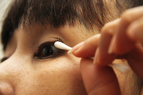 Phai lam gi khi co ran ky sinh tren mi mat?