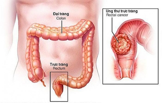 Ha Noi: Tam soat ung thu dai truc trang mien phi