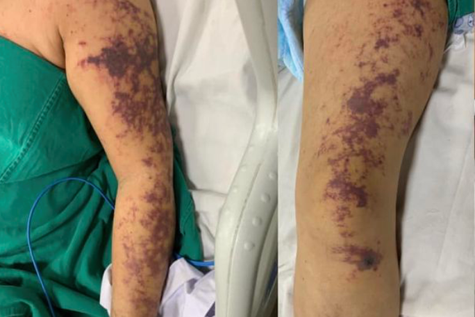 Nhiem lien cau khuan do an long lon: Dau hieu benh de nham lan