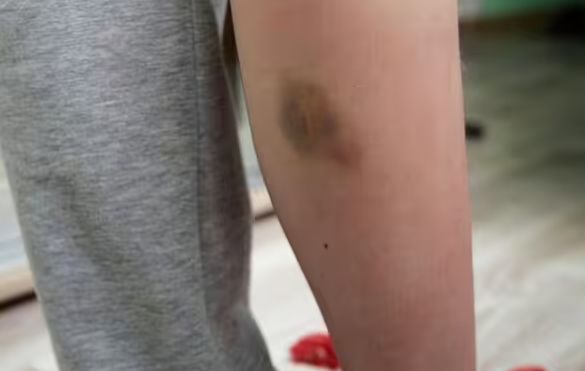 Thay dau hieu nay tren da, coi chung ung thu mau