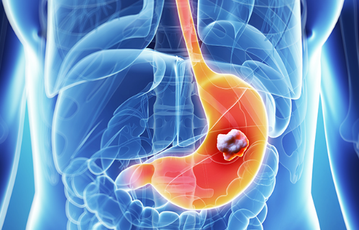 Dau hieu khi an canh bao ung thu da day nhieu nguoi bo qua