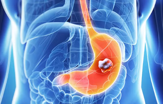 Dau hieu khi an canh bao ung thu da day nhieu nguoi bo qua