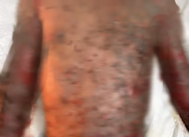 Nam thanh nien mac benh hiem on dinh trong ngay xuat vien-Hinh-2