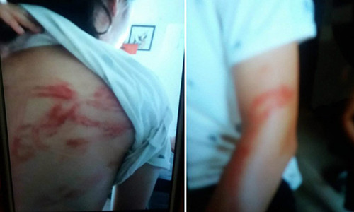 Hình ảnh những vết thâm tím, sẹo vẫn còn in hằn trên người cháu P. bị bố bạo hành.