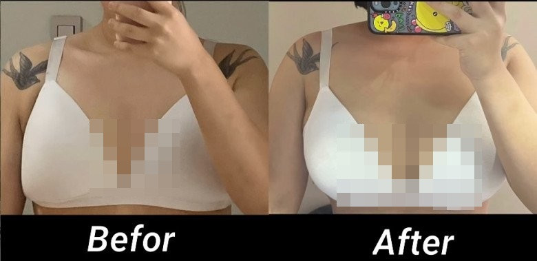 Người đẹp công nhận rằng, cô đã thực hiện phẫu thuật nâng cấp vòng 1. Ca phẫu thuật rất thành công và cô rất hài lòng với khuôn ngực và body hiện tại.