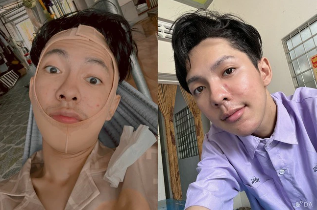 Đỉnh điểm năm 2020 cái tên Võ Thành Ý vụt sáng, anh kiếm được nhiều tiền hơn và chịu chi 800 triệu đồng để phẫu thuật thẩm mỹ.