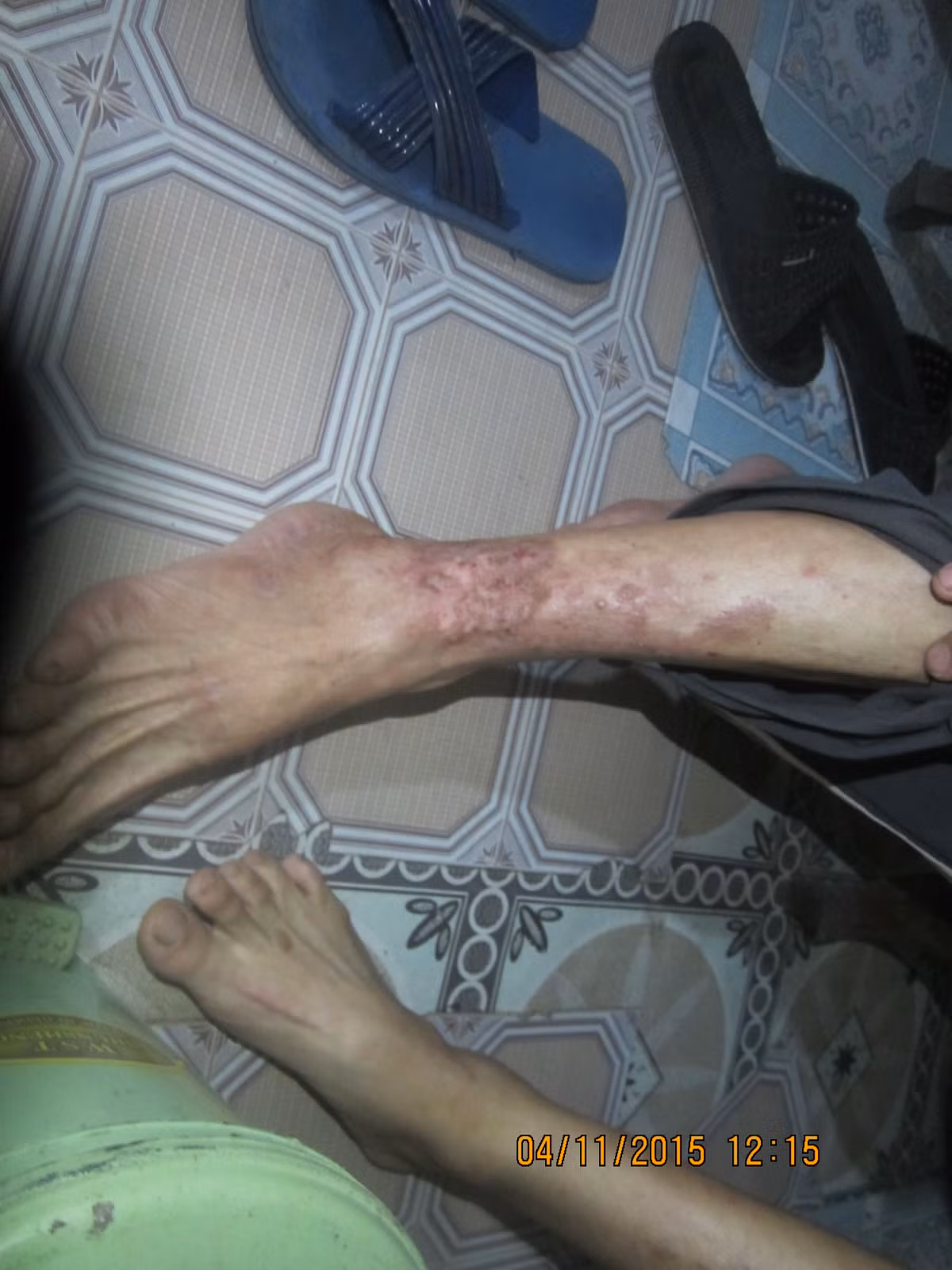 Không chỉ bị ô nhiễm về không khí, người dân cho biết, khu vực này còn bị ô nhiễm nghiêm trọng về nguồn nước. “Nhà tôi liền kề với bãi rác. Điểm tập kết rác thải của nhà máy cao như núi, gấp hai lần nóc nhà tôi. Có cái ao nhỏ gần đó, thỉnh thoảng tôi hay xuống cắt cỏ, rửa chân tay, nhưng từ khi nhà máy rác hoạt động, có lần xuống rửa chân về bị lở loét, ngứa thành vùng như bị tổ đỉa nên tôi chẳng dám lội xuống nữa.” – ông Hoàng Ngọc Ân kể lại.