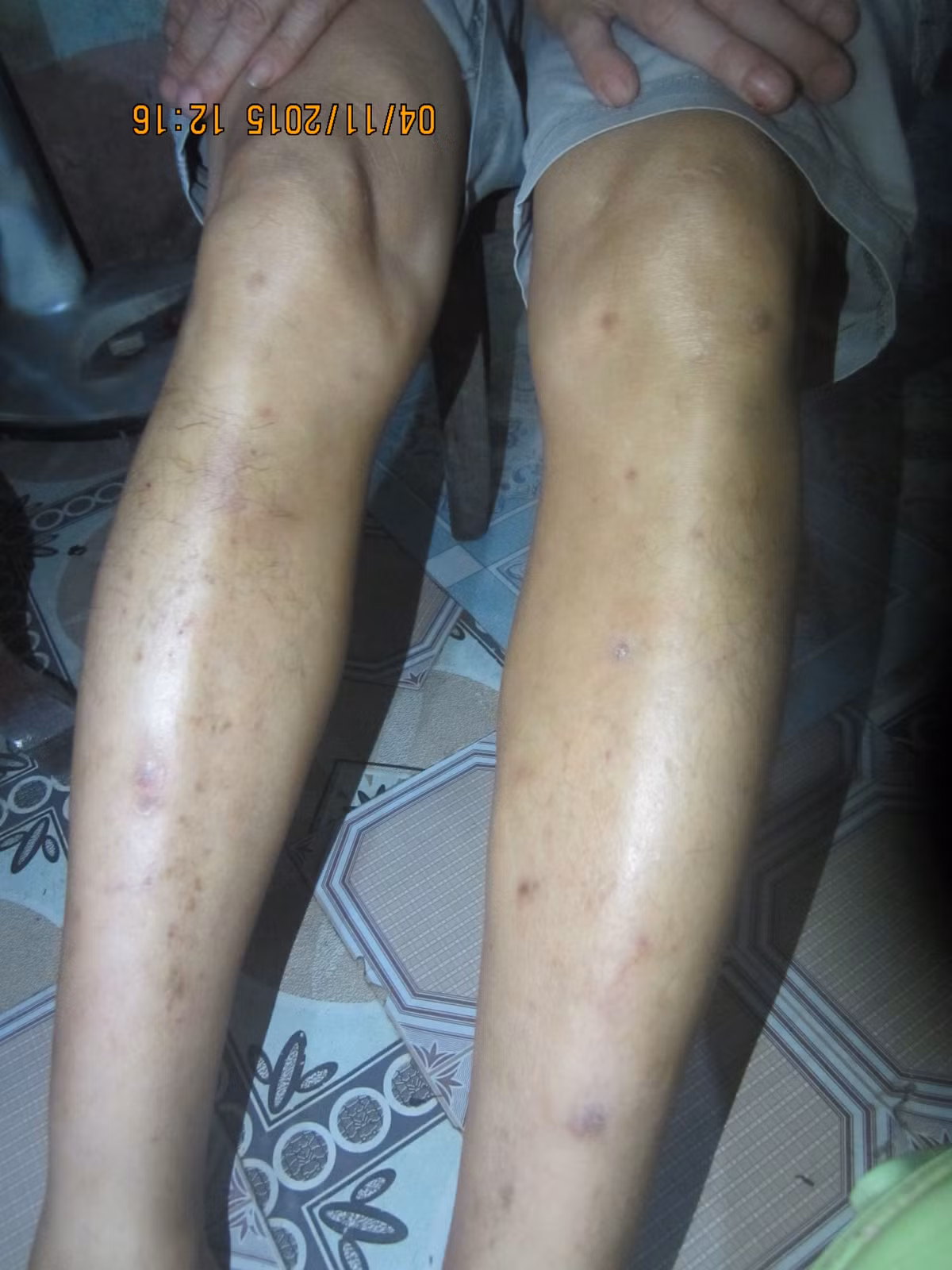 Chân của một người dân chi chít các nốt thâm và vết ngứa do bị muỗi đốt.