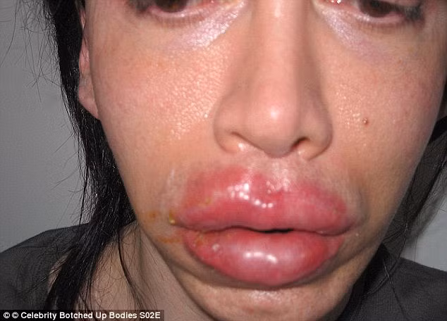 Đôi môi sưng vều, hậu quả của thẩm mỹ hỏng đã để lại rất nhiều hệ lụy cho Pete Burns về sau này.