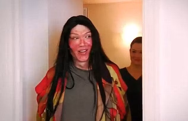 Khuôn mặt Pete bị phá hỏng bởi chất dịch làm đầy bơm môi bị rỉ ra ngoài.