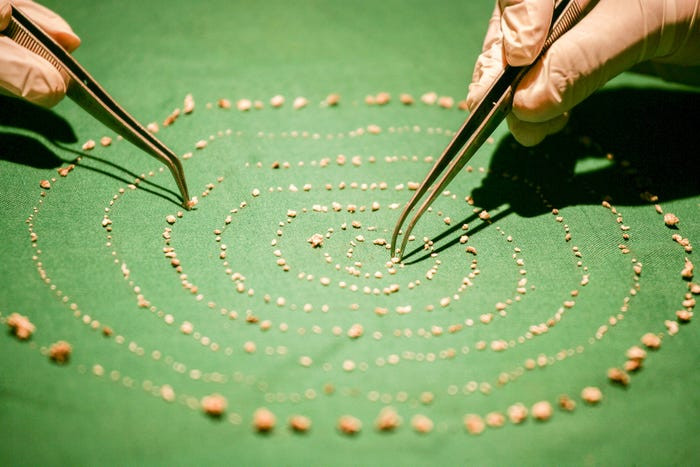 Các bác sĩ tại một bệnh viện ở Chennai, Ấn Độ, đã lấy hơn 500 chiếc răng ra khỏi miệng của một bé trai 7 tuổi hồi tháng 8/2019.