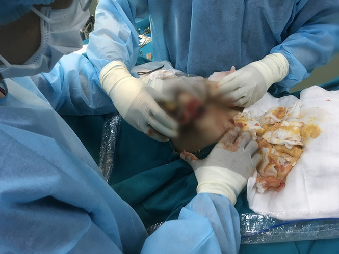 Các bác sỹ phẫu thuật nạo silicon trong ngực chị H.