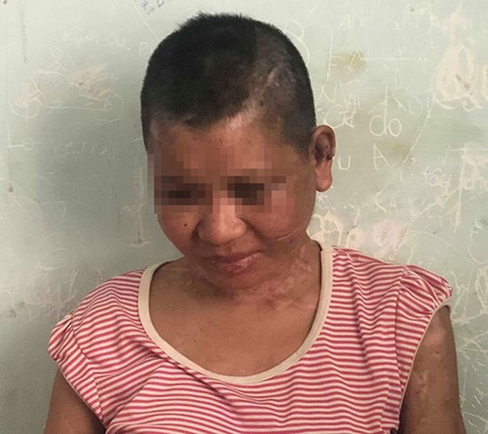 Bác sĩ Trung tâm y tế huyện Đăk Glei cho biết, khi tiếp nhận bệnh nhân, trên cơ thể Y Nhiêu có nhiều thương tích. Di chứng về bỏng để lại nhiều sẹo trên người. Bị thương nhiễm trùng ở hai bên tai. Ngón tay cái bị dập nát cơ hiện trong tình trạng nhiễm trùng, có mủ và hoại tử. Ngoài ra bệnh nhân còn bị thiếu máu. (Ảnh: Thanh Niên). Bác sĩ Trung tâm y tế huyện Đăk Glei cho biết, khi tiếp nhận bệnh nhân, trên cơ thể Y Nhiêu có nhiều thương tích. Di chứng về bỏng để lại nhiều sẹo trên người. Bị thương nhiễm trùng ở hai bên tai. Ngón tay cái bị dập nát cơ hiện trong tình trạng nhiễm trùng, có mủ và hoại tử. Ngoài ra bệnh nhân còn bị thiếu máu. (Ảnh: Thanh Niên).