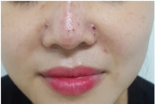 Bệnh nhân bị biến chứng khi tiêm filler vào mũi tại một spa ở Hà Nội.