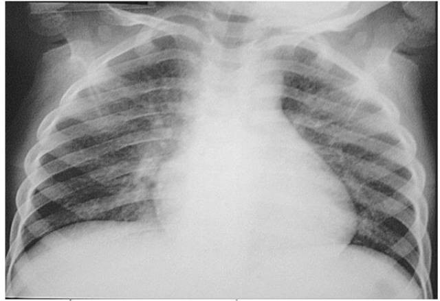 Hình ảnh Xquang bệnh nhân bị viêm phổi sau khi sặc dầu hoả.