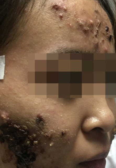Hình ảnh tổn thương trên trán và hai má bệnh nhân.