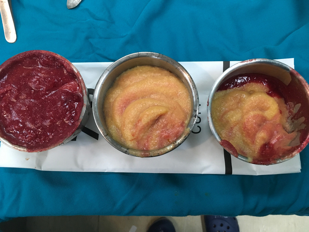 Từ vùng ngực của chị H lấy ra hàng lít chất lỏng màu vàng nhạt