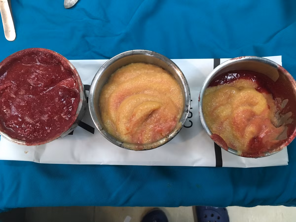 Từ vùng ngực của chị H lấy ra hàng lít chất lỏng màu vàng nhạt Từ vùng ngực của chị H lấy ra hàng lít chất lỏng màu vàng nhạt