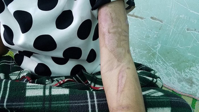 Theo Zing.vn, Công an TP Pleiku xác định bà Nga - người tra tấn chị Y Nhiêu, có biểu hiện ngáo đá. Tuy nhiên, theo lời luật sư Dương Lê Sơn (Đoàn Luật sư Đắk Lắk), pháp luật hiện hành không xem "ngáo đá" là mất năng lực hành vi dân sự. Do vậy, cần tổ chức giám định xem trước và trong khi phạm tội, bà Nga có bị hạn chế trách nhiệm hình sự hay không. Nếu có thì bắt buộc chữa bệnh rồi mới xử lý hình sự, nếu không sẽ xử lý luôn. (Ảnh: Người Lao Động). Theo Zing.vn, Công an TP Pleiku xác định bà Nga - người tra tấn chị Y Nhiêu, có biểu hiện ngáo đá. Tuy nhiên, theo lời luật sư Dương Lê Sơn (Đoàn Luật sư Đắk Lắk), pháp luật hiện hành không xem "ngáo đá" là mất năng lực hành vi dân sự. Do vậy, cần tổ chức giám định xem trước và trong khi phạm tội, bà Nga có bị hạn chế trách nhiệm hình sự hay không. Nếu có thì bắt buộc chữa bệnh rồi mới xử lý hình sự, nếu không sẽ xử lý luôn. (Ảnh: Người Lao Động).