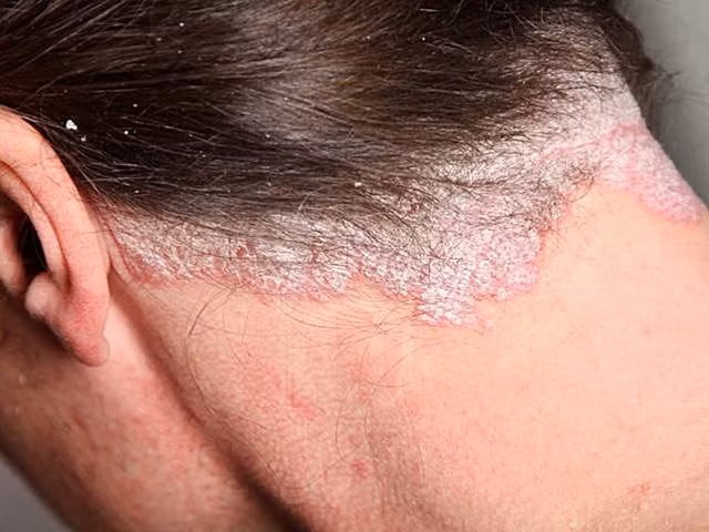 Những trường hợp nặng, người bệnh có thể xuất hiện nhiều mụn mủ hoặc đỏ da toàn bộ cơ thể.