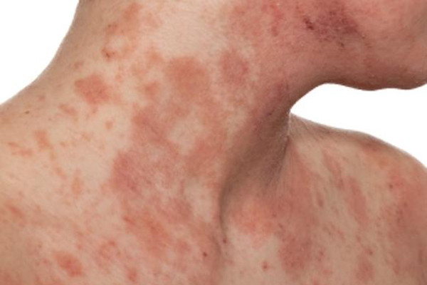 Biểu hiện bệnh là đám da đỏ ranh giới không rõ, các sẩn và đám sẩn, mụn nước tiết dịch, không có vẩy da. Da bị phù nề, chảy dịch, đóng vảy tiết. Các vết xước do gãi tạo vết chợt, bội nhiễm tụ cầu tạo các mụn mủ và vẩy tiết vàng. Bệnh thường cư trú ở trán, má, cằm, nặng hơn có thể lan ra tay, thân mình.